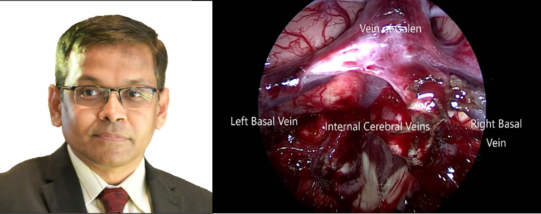 "Revolutionizing Neurosurgery: PGIMER Pioneering Minimally Invasive Technique for Giant Pineal Tumors Using Exoscope and Endoscope"